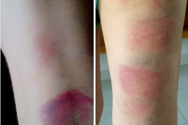 Chân của một học sinh bị bầm tím sau khi bị cô Huyền đánh. Ảnh phụ huynh chụp